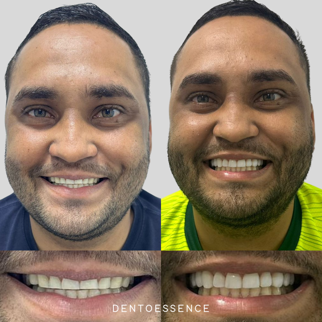 antes e depois 1,2 (1)